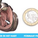 Kleinste draadloze pacemaker ter wereld in het Catharina Ziekenhuis in Eindhoven