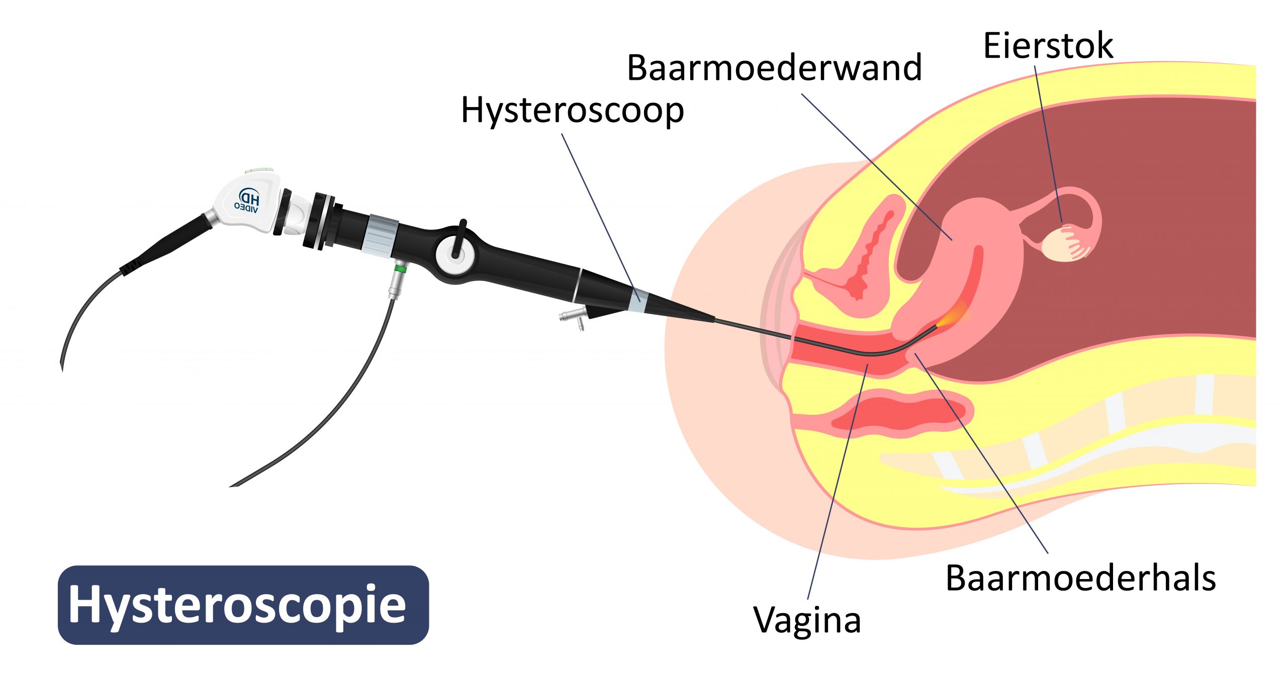 Hysteroscopie.jpg