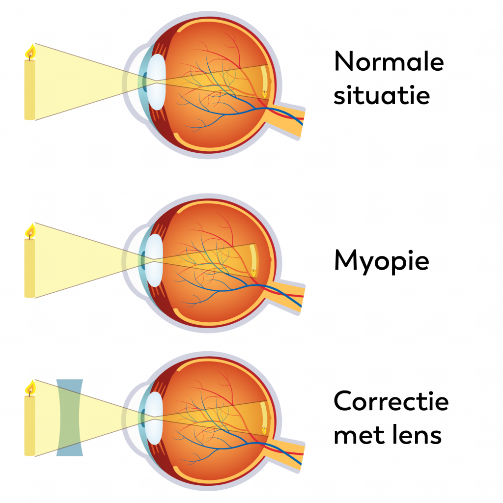 Schema myoop oog