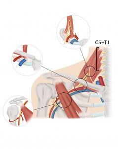 Thoracic Outlet Syndrome (TOS) (Folder) - Catharina Ziekenhuis