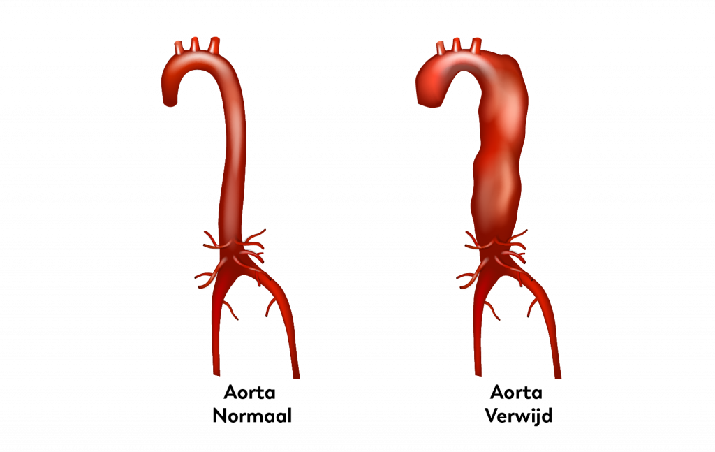 Aorta normaal en verwijd